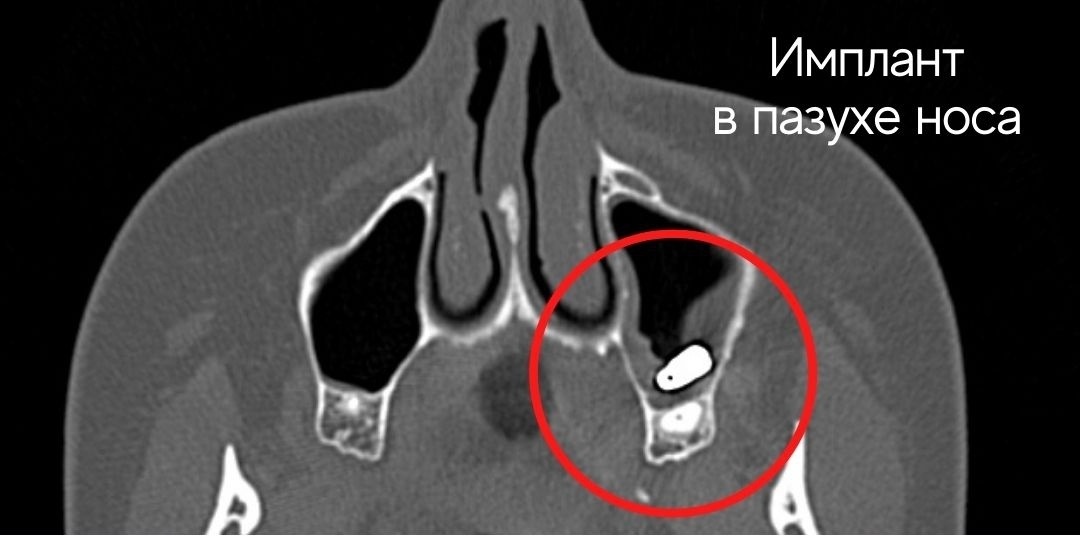 Нижегородский ЛОР-врач извлек зубной имплант из носа пациента - фото 1