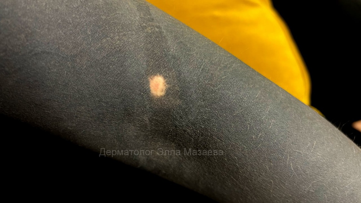 Нижегородцам напомнили об опасностях нанесения тату на родинки - фото 1