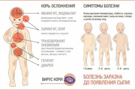 Первый случай заражения корью зарегистрирован в Нижегородской области