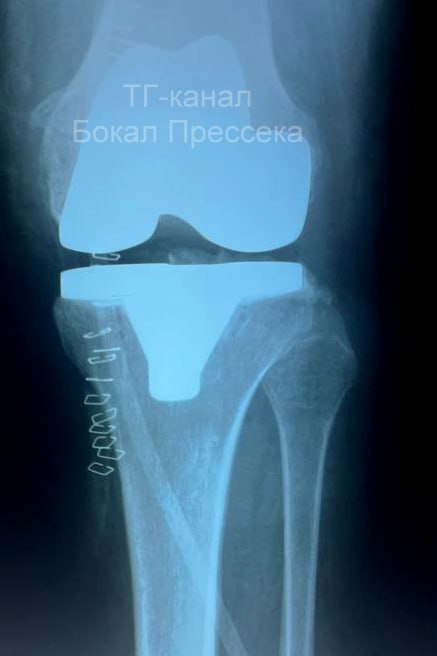 Нижегородке с экстремально большим весом заменили коленный сустав