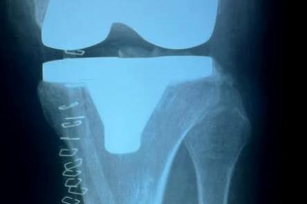 Нижегородке с экстремально большим весом заменили коленный сустав